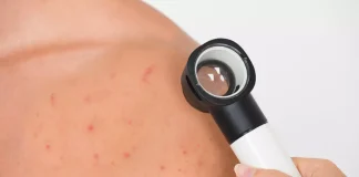 Foliculita: cum apare, simptome si ce tratament exista?